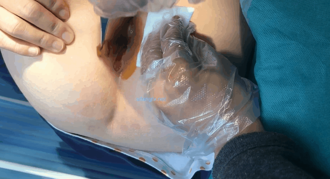 图片[4]-医院内部教学视频流出给女痔疮患者换药过程-山相欢迎您！